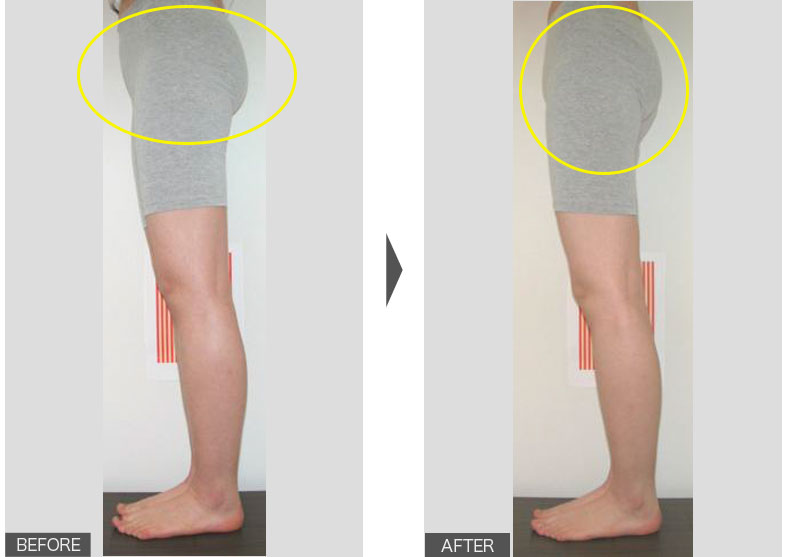 女性／2ヶ月／姿勢の変化、骨盤の前傾の変化